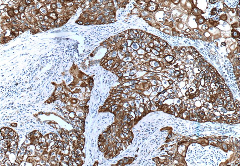 Immunohistochemistry of paraffin-embedded human lung cancer tissue slide using Catalog No:109792(KRT14 Antibody) at dilution of 1:200 (under 10x lens)
