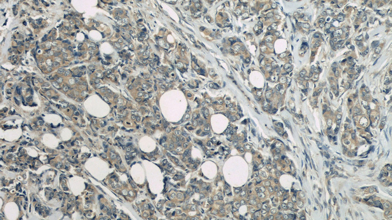 Immunohistochemistry of paraffin-embedded human breast cancer slide using Catalog No:113496(PAK1 Antibody) at dilution of 1:50