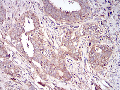 Fig3: Immunohistochemical analysis of paraffin-embedded human cervical cancer tissue using anti-VTN antibody. Counter stained with hematoxylin.