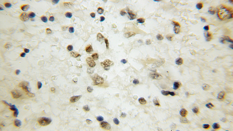 Immunohistochemical of paraffin-embedded human gliomas using Catalog No:111966(KCNIP3 antibody) at dilution of 1:50 (under 10x lens)