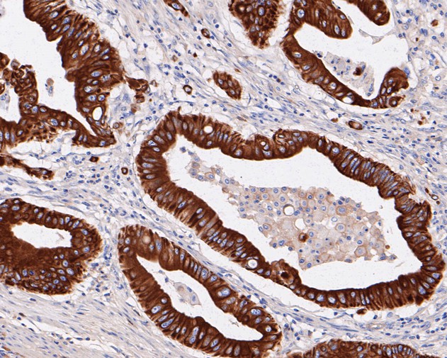 Fig2:; Immunohistochemical analysis of paraffin-embedded human colon carcinoma tissue using anti-SLC22A3 antibody. The section was pre-treated using heat mediated antigen retrieval with Tris-EDTA buffer (pH 8.0-8.4) for 20 minutes.The tissues were blocked in 5% BSA for 30 minutes at room temperature, washed with ddH; 2; O and PBS, and then probed with the primary antibody ( 1/50) for 30 minutes at room temperature. The detection was performed using an HRP conjugated compact polymer system. DAB was used as the chromogen. Tissues were counterstained with hematoxylin and mounted with DPX.
