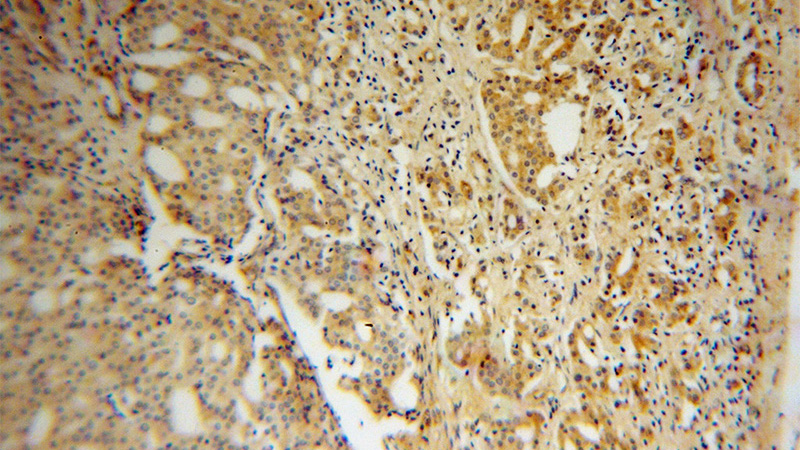 Immunohistochemical of paraffin-embedded human prostate cancer using Catalog No:110894(GBP5 antibody) at dilution of 1:100 (under 10x lens)