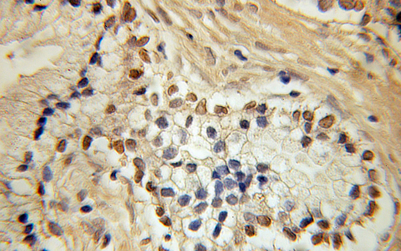 Immunohistochemical of paraffin-embedded human prostate cancer using Catalog No:111309(HEY2 antibody) at dilution of 1:100 (under 10x lens)