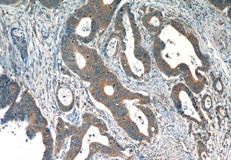 Immunohistochemistry of paraffin-embedded human colon cancer slide using Catalog No:116202(TMF1 Antibody) at dilution of 1:50