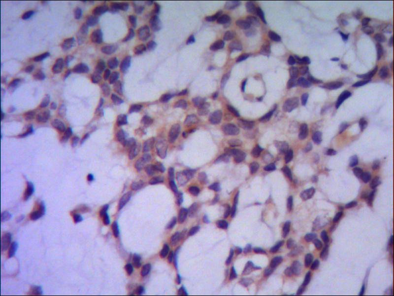 IHC of paraffin-embedded human breast cancer using anti-PPP1A mouse mAb diluted 1/500-1/1000.