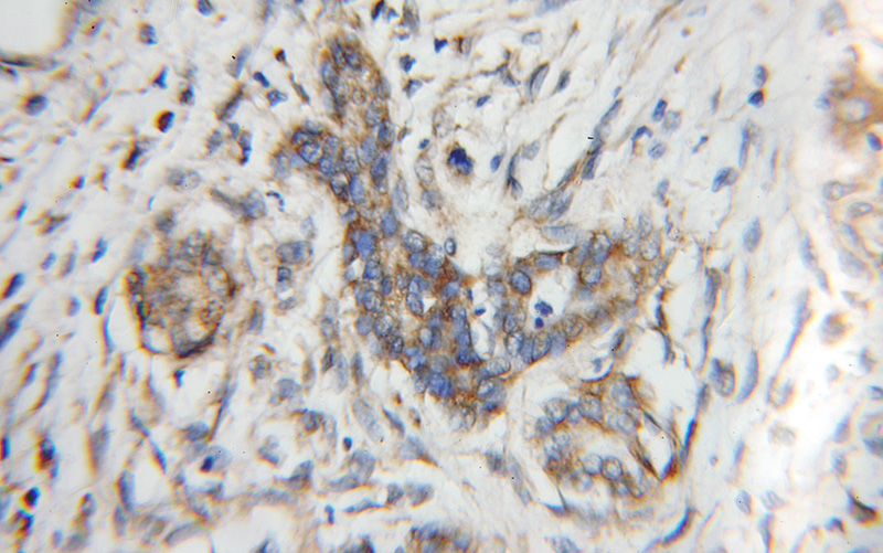 Immunohistochemical of paraffin-embedded human pancreas cancer using Catalog No:116136(TIMM9 antibody) at dilution of 1:100 (under 10x lens)