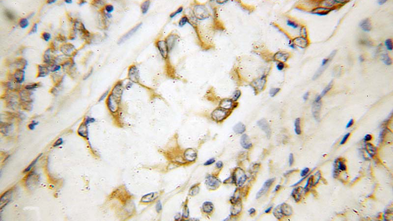 Immunohistochemical of paraffin-embedded human colon cancer using Catalog No:109262(ITGB3BP antibody) at dilution of 1:100 (under 25x lens)