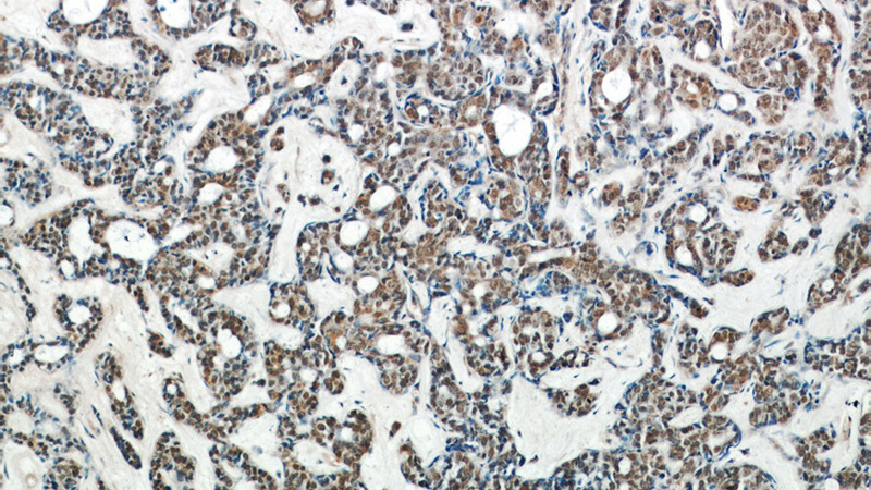 Immunohistochemical of paraffin-embedded human cervical cancer using Catalog No:107544(WTAP antibody) at dilution of 1:50 (under 10x lens)