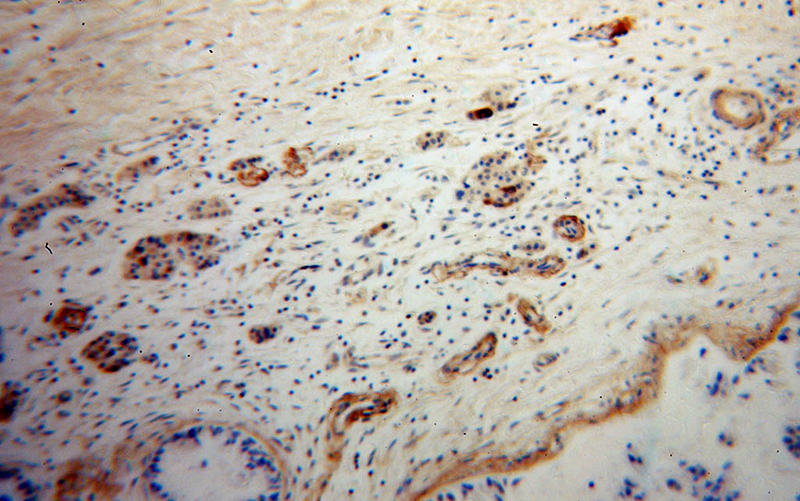 Immunohistochemical of paraffin-embedded human pancreas cancer using Catalog No:113226(NPY antibody) at dilution of 1:50 (under 10x lens)