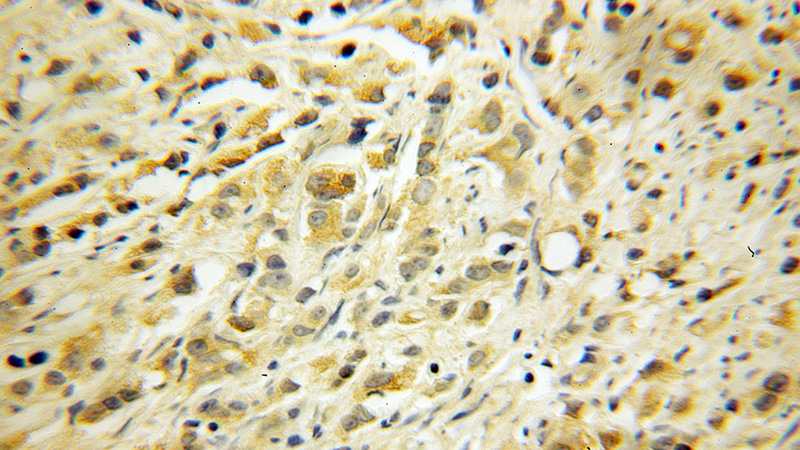 Immunohistochemical of paraffin-embedded human gliomas using Catalog No:114114(PPP3R1 antibody) at dilution of 1:100 (under 10x lens)
