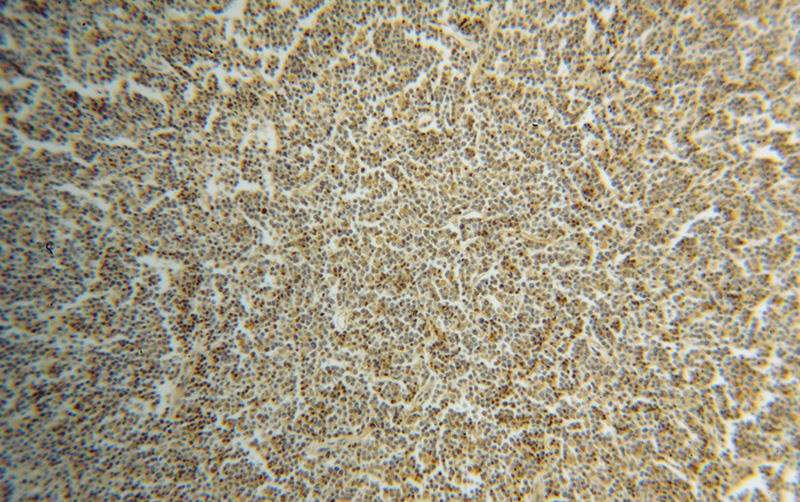 Immunohistochemical of paraffin-embedded human lymphoma using Catalog No:112172(LCK antibody) at dilution of 1:100 (under 10x lens)