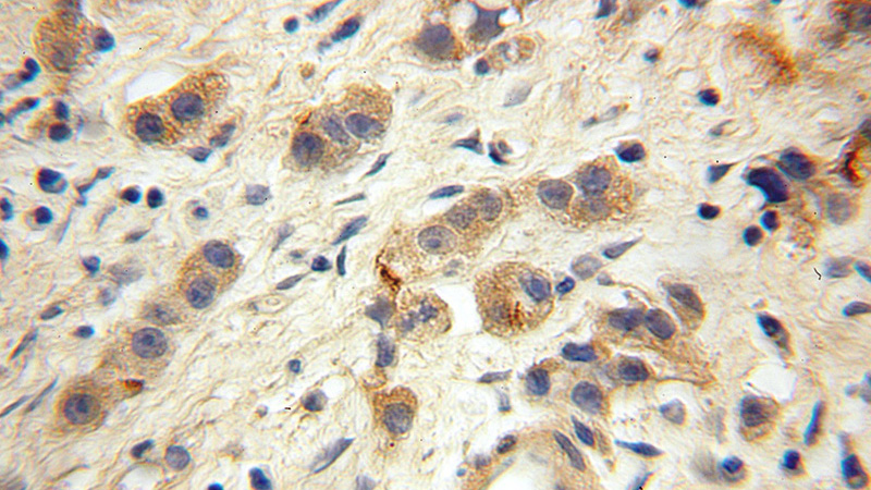 Immunohistochemical of paraffin-embedded human gliomas using Catalog No:112033(GLS antibody) at dilution of 1:100 (under 10x lens)