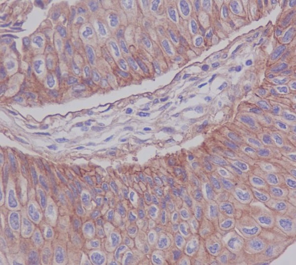 Immunohistochemical analysis of paraffin-embedded human blader cancer, using JAM1 Antibody.