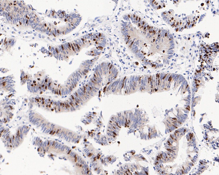 Fig5:; Immunohistochemical analysis of paraffin-embedded human colon carcinoma tissue using anti-Phospho-Histone H1.3(T17)+Histone H1.4(T17) antibody. The section was pre-treated using heat mediated antigen retrieval with sodium citrate buffer (pH 6.0) for 20 minutes. The tissues were blocked in 5% BSA for 30 minutes at room temperature, washed with ddH; 2; O and PBS, and then probed with the primary antibody ( 1/200) for 30 minutes at room temperature. The detection was performed using an HRP conjugated compact polymer system. DAB was used as the chromogen. Tissues were counterstained with hematoxylin and mounted with DPX.