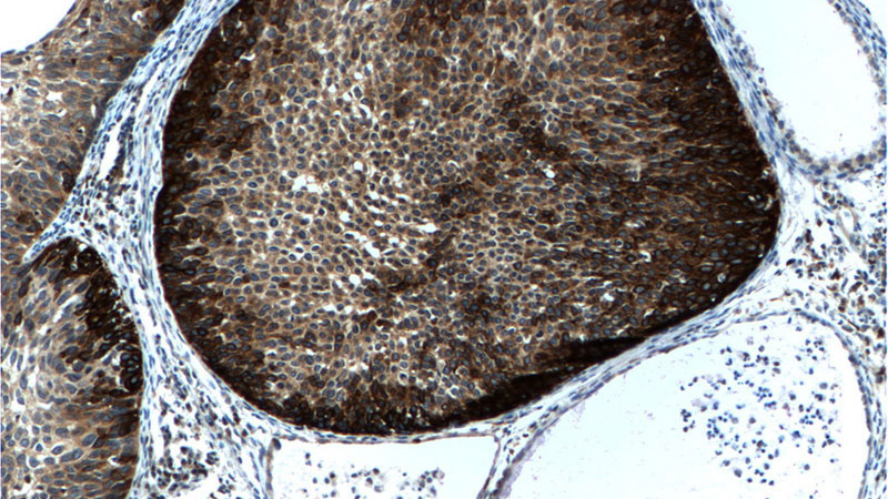 Immunohistochemistry of paraffin-embedded human cervical cancer tissue slide using Catalog No:107229(KRT14 Antibody) at dilution of 1:200 (under 10x lens). heat mediated antigen retrieved with Tris-EDTA buffer(pH9).
