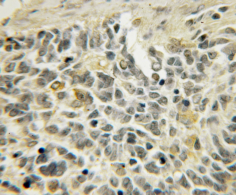 Immunohistochemical of paraffin-embedded human medulloblastoma using Catalog No:113058(NDRG4 antibody) at dilution of 1:50 (under 10x lens)