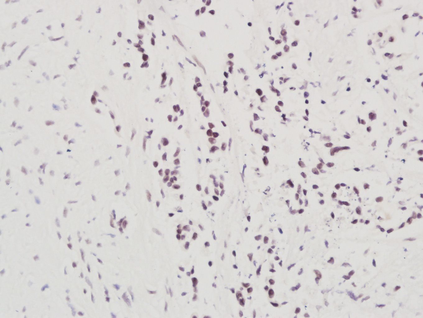 Fig3: Paraformaldehyde-fixed, paraffin embedded (Human stomach cancer); Antigen retrieval by boiling in sodium citrate buffer (pH6.0) for 15min; Block endogenous peroxidase by 3% hydrogen peroxide for 20 minutes; Blocking buffer (normal goat serum) at 37℃ for 30min; Antibody incubation with (NARG1) Polyclonal Antibody, Unconjugated at 1:400 overnight at 4℃, followed by a conjugated secondary antibody (sp-0023) for 20 minutes and DAB staining.