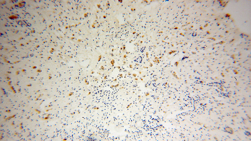 Immunohistochemical of paraffin-embedded human breast cancer using Catalog No:116535(UBE2S antibody) at dilution of 1:50 (under 10x lens)