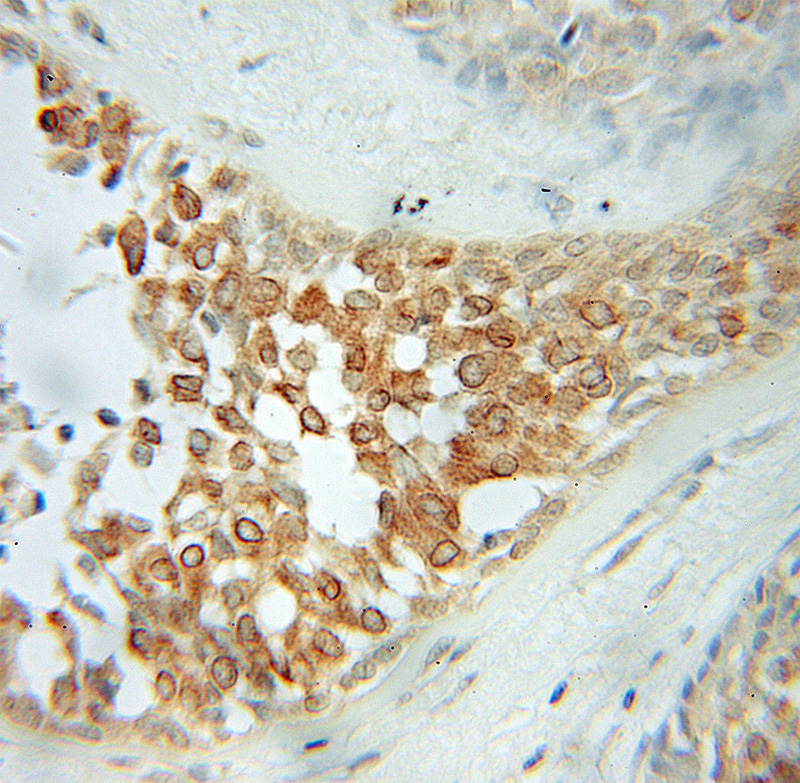 Immunohistochemical of paraffin-embedded human breast cancer using Catalog No:113952(PLDN antibody) at dilution of 1:50 (under 10x lens)