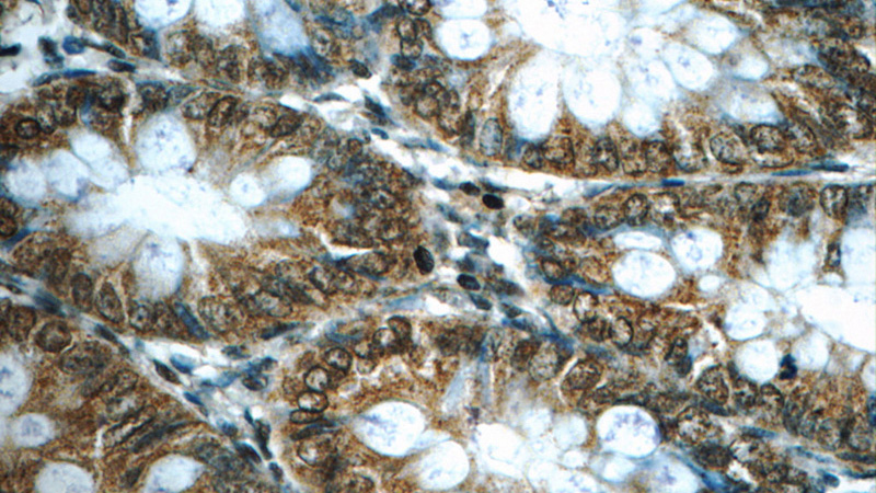 Immunohistochemistry of paraffin-embedded human colon tissue slide using Catalog No:110413(EXOSC7 Antibody) at dilution of 1:50 (under 40x lens)