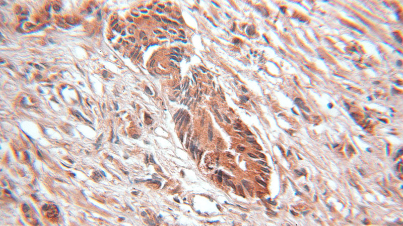Immunohistochemical of paraffin-embedded human prostate cancer using Catalog No:115595(SRP9 antibody) at dilution of 1:100 (under 10x lens)