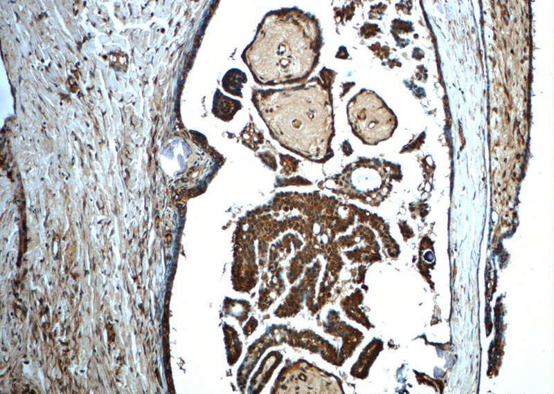 Immunohistochemistry of paraffin-embedded human ovary tumor slide using Catalog No:111784(IMPDH1 Antibody) at dilution of 1:50