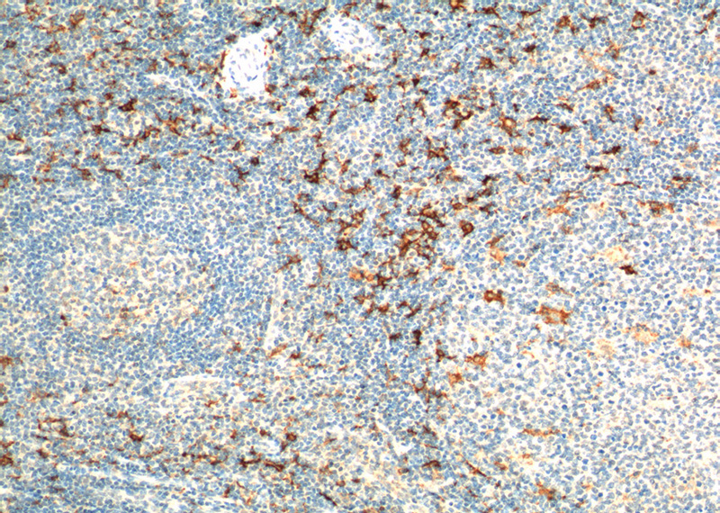 Immunohistochemistry of paraffin-embedded human tonsillitis tissue slide using Catalog No:109059(CD163 Antibody) at dilution of 1:200 (under 10x lens). heat mediated antigen retrieved with Tris-EDTA buffer(pH9).