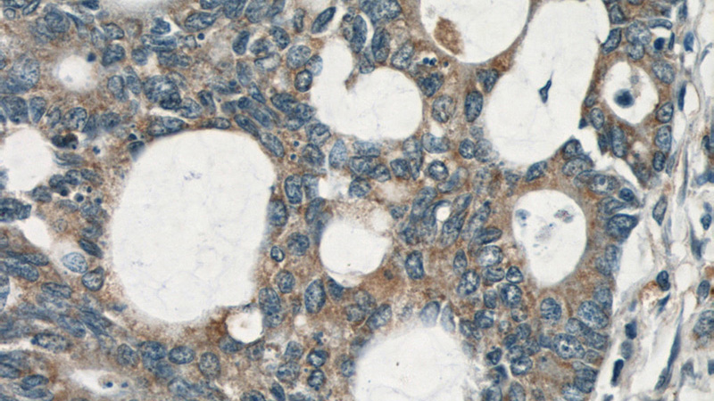 Immunohistochemical of paraffin-embedded human colon cancer using Catalog No:114657(RHOA antibody) at dilution of 1:50 (under 40x lens)