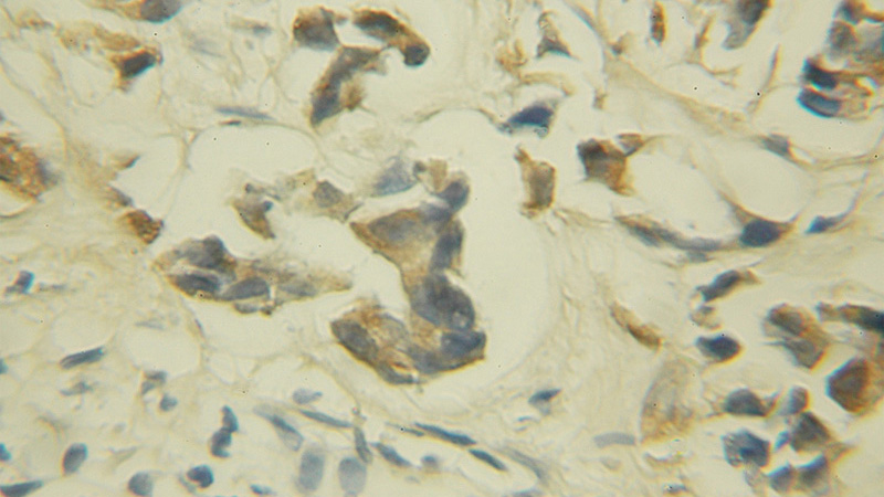 Immunohistochemical of paraffin-embedded human prostate cancer using Catalog No:115873(TBCE antibody) at dilution of 1:50 (under 10x lens)