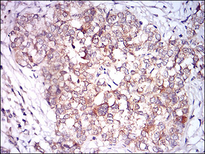 Immunohistochemical analysis of paraffin-embedded bladder cancer tissues using CAMK2G mouse mAb with DAB staining.