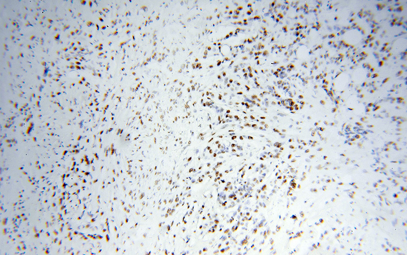 Immunohistochemical of paraffin-embedded human colon cancer using Catalog No:111911(KAP1 antibody) at dilution of 1:100 (under 10x lens)
