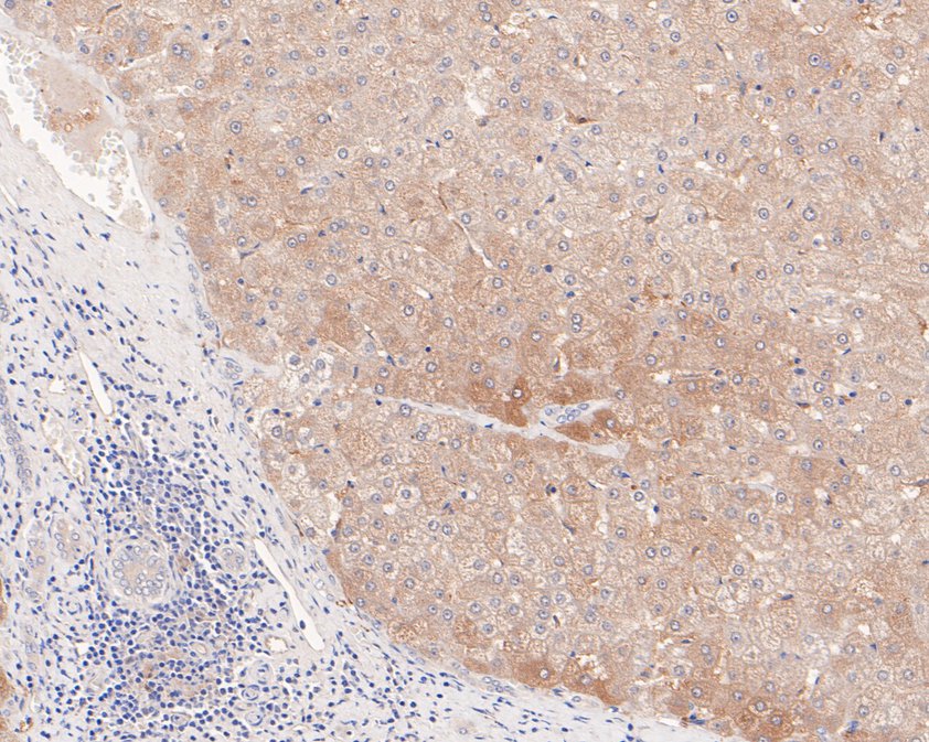 Fig4:; Immunohistochemical analysis of paraffin-embedded human liver tissue using anti-CLIC2 antibody. The section was pre-treated using heat mediated antigen retrieval with Tris-EDTA buffer (pH 9.0) for 20 minutes.The tissues were blocked in 1% BSA for 30 minutes at room temperature, washed with ddH; 2; O and PBS, and then probed with the primary antibody ( 1/400) for 30 minutes at room temperature. The detection was performed using an HRP conjugated compact polymer system. DAB was used as the chromogen. Tissues were counterstained with hematoxylin and mounted with DPX.