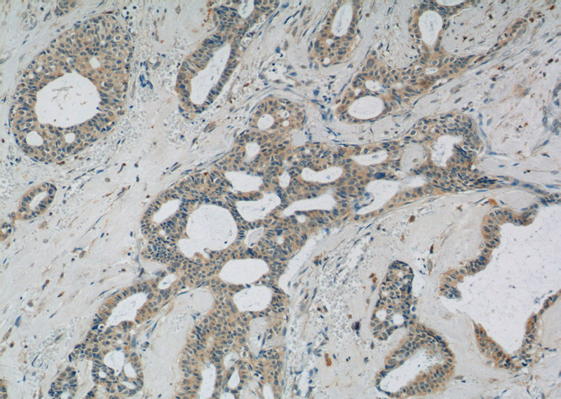 Immunohistochemistry of paraffin-embedded human breast cancer tissue slide using Catalog No:108646(C11orf83 Antibody) at dilution of 1:50 (under 10x lens)