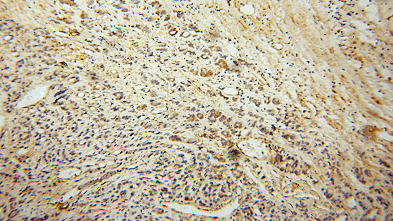Immunohistochemical of paraffin-embedded human gliomas using Catalog No:113291(NOG antibody) at dilution of 1:50 (under 10x lens)