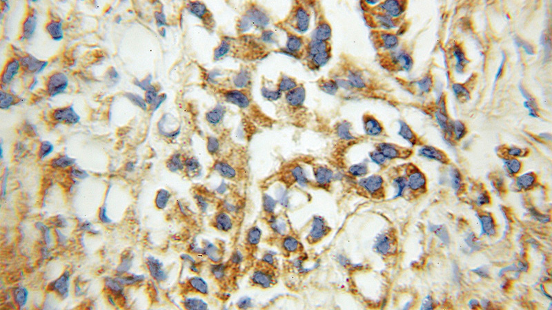 Immunohistochemical of paraffin-embedded human prostate cancer using Catalog No:110293(ECHS1 antibody) at dilution of 1:100 (under 10x lens)