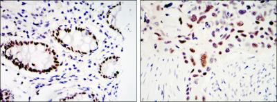 Immunohistochemical analysis of paraffin-embedded colon cancer tissues (left) and lung cancer tissues (right) using KLF4 mouse mAb with DAB staining