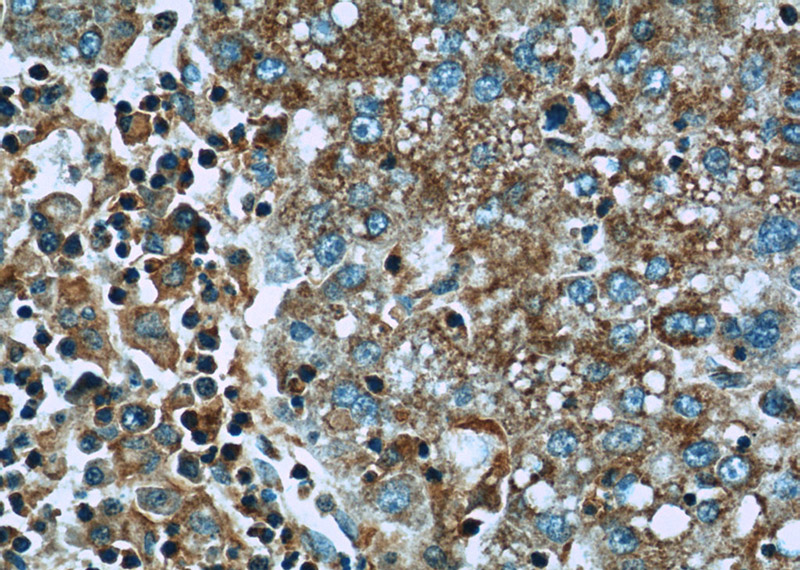 Immunohistochemistry of paraffin-embedded human liver cancer slide using Catalog No:111682(IGF2R-Specific Antibody) at dilution of 1:50