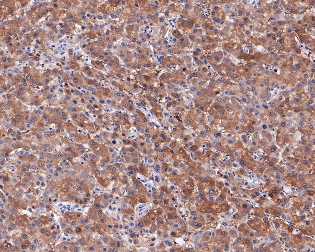 Fig2:; Immunohistochemical analysis of paraffin-embedded human liver carcinoma tissue using anti-Neurocan antibody. The section was pre-treated using heat mediated antigen retrieval with Tris-EDTA buffer (pH 9.0) for 20 minutes.The tissues were blocked in 5% BSA for 30 minutes at room temperature, washed with ddH; 2; O and PBS, and then probed with the primary antibody ( 1/50) for 30 minutes at room temperature. The detection was performed using an HRP conjugated compact polymer system. DAB was used as the chromogen. Tissues were counterstained with hematoxylin and mounted with DPX.