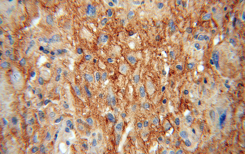 Immunohistochemical of paraffin-embedded human gliomas using Catalog No:113028(NCAM2 antibody) at dilution of 1:100 (under 40x lens)