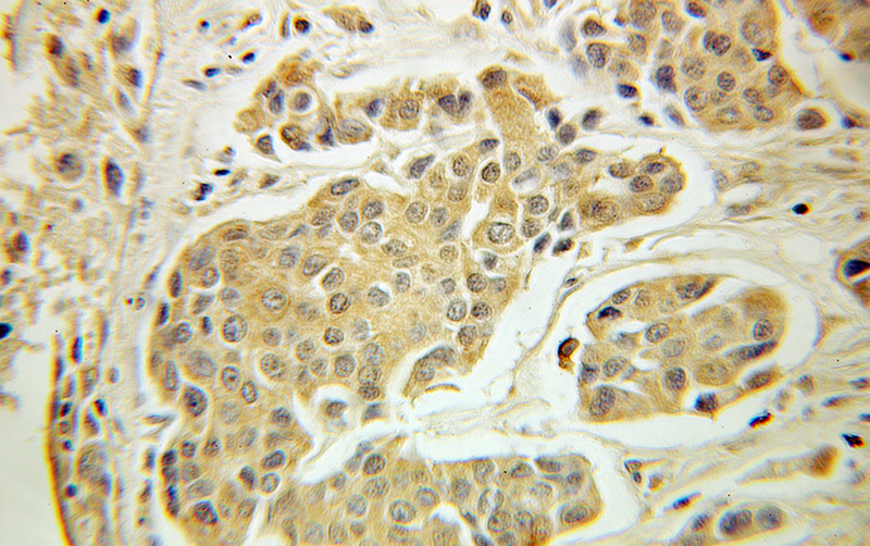 Immunohistochemical of paraffin-embedded human breast cancer using Catalog No:111243(GTPBP3 antibody) at dilution of 1:100 (under 10x lens)