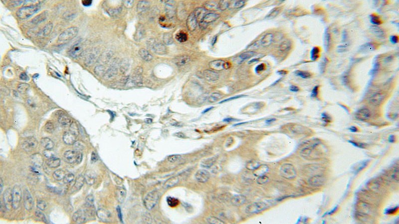 Immunohistochemical of paraffin-embedded human colon cancer using Catalog No:114318(PTPN2 antibody) at dilution of 1:50 (under 40x lens)