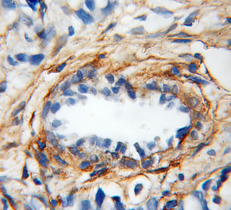 Immunohistochemical of paraffin-embedded human prostate cancer using Catalog No:110936(GSN antibody) at dilution of 1:50 (under 10x lens)