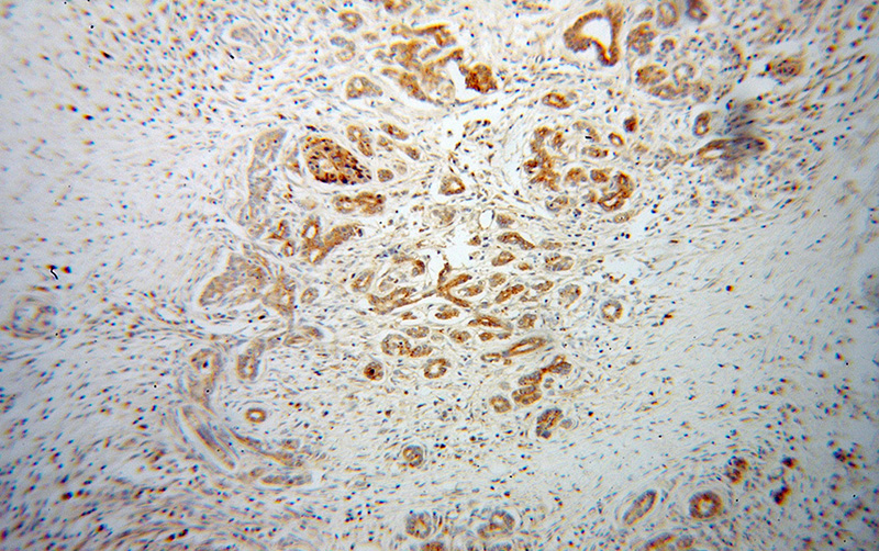 Immunohistochemical of paraffin-embedded human pancreas cancer using Catalog No:110767(GAA antibody) at dilution of 1:50 (under 10x lens)