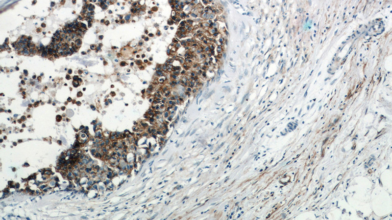 Immunohistochemistry of paraffin-embedded human breast cancer slide using Catalog No:107055(ANXA2 Antibody) at dilution of 1:50
