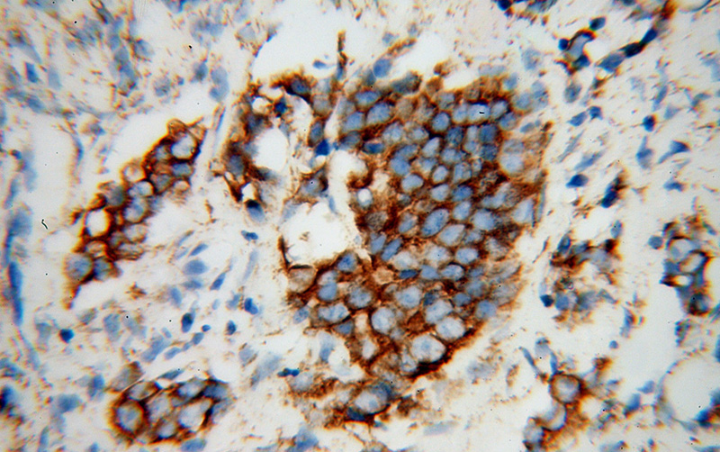 Immunohistochemical of paraffin-embedded human gliomas using Catalog No:112662(IMMT antibody) at dilution of 1:100 (under 40x lens)