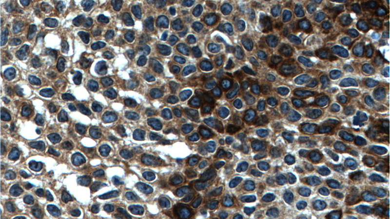 Immunohistochemistry of paraffin-embedded human cervical cancer tissue slide using Catalog No:107229(KRT14 Antibody) at dilution of 1:200 (under 40x lens). heat mediated antigen retrieved with Tris-EDTA buffer(pH9).