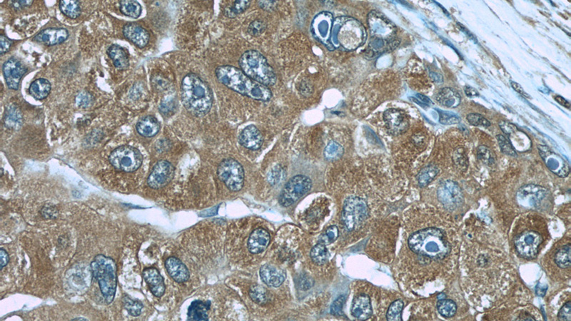 Immunohistochemistry of paraffin-embedded human liver cancer slide using Catalog No:107502(RBP4 Antibody) at dilution of 1:50
