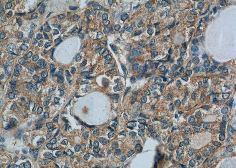 Immunohistochemistry of paraffin-embedded human thyroid cancer tissue slide using Catalog No:117222(BRAF Antibody) at dilution of 1:50 (under 40x lens)