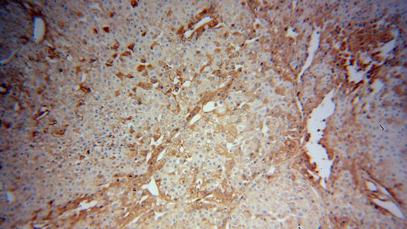 Immunohistochemical of paraffin-embedded human liver cancer using Catalog No:108037(APOA1 antibody) at dilution of 1:100 (under 10x lens)