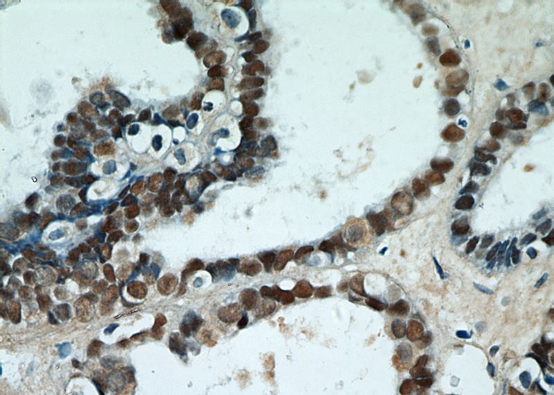 Immunohistochemical of paraffin-embedded human ovary tumor using Catalog No:113572(pan-PAX antibody) at dilution of 1:50 (under 40x lens)